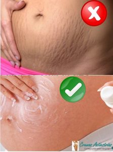 mejor crema anti-estrías para el embarazo